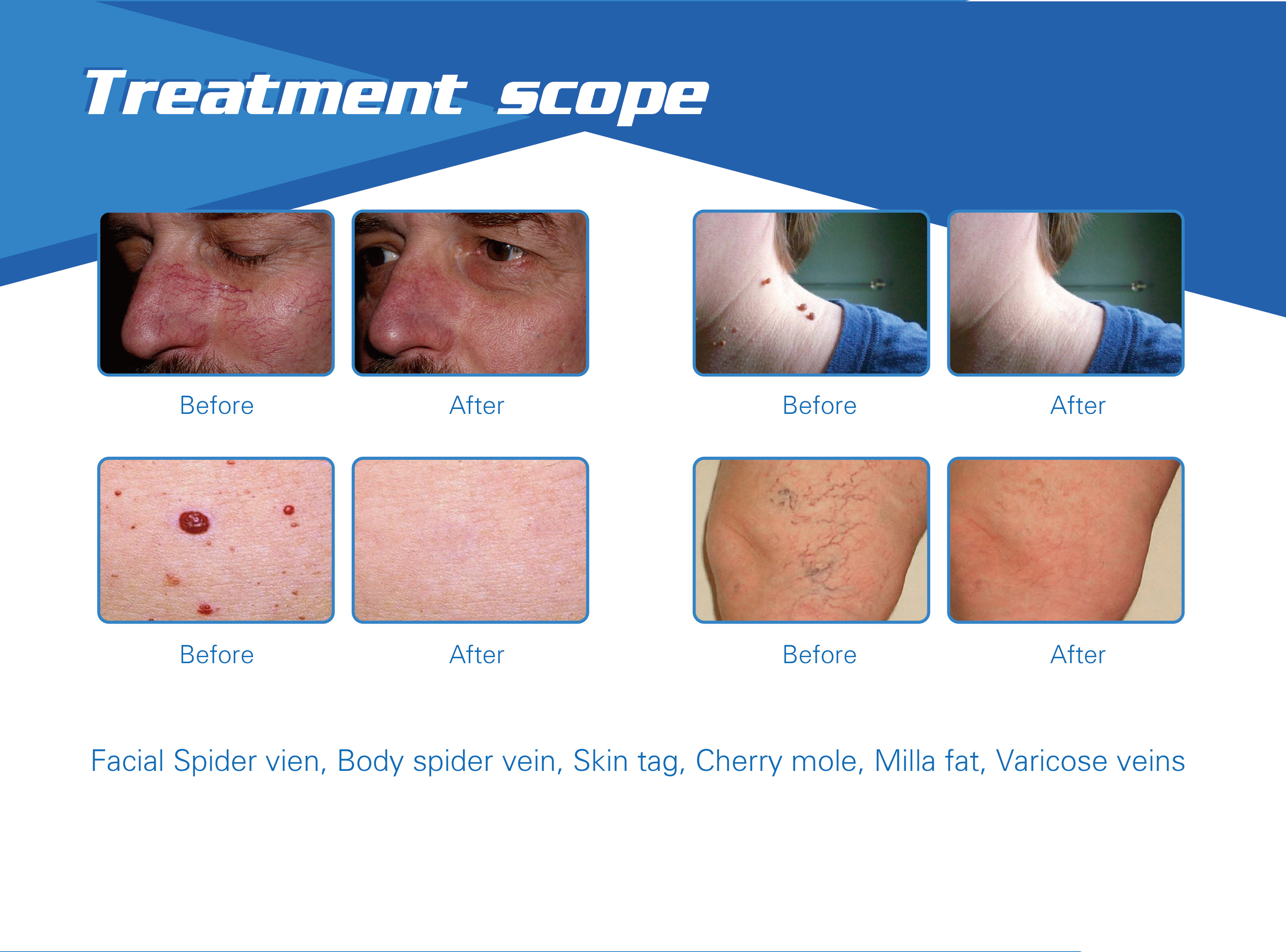 980nm diode laser 30w therapy laser spider vein removal machine