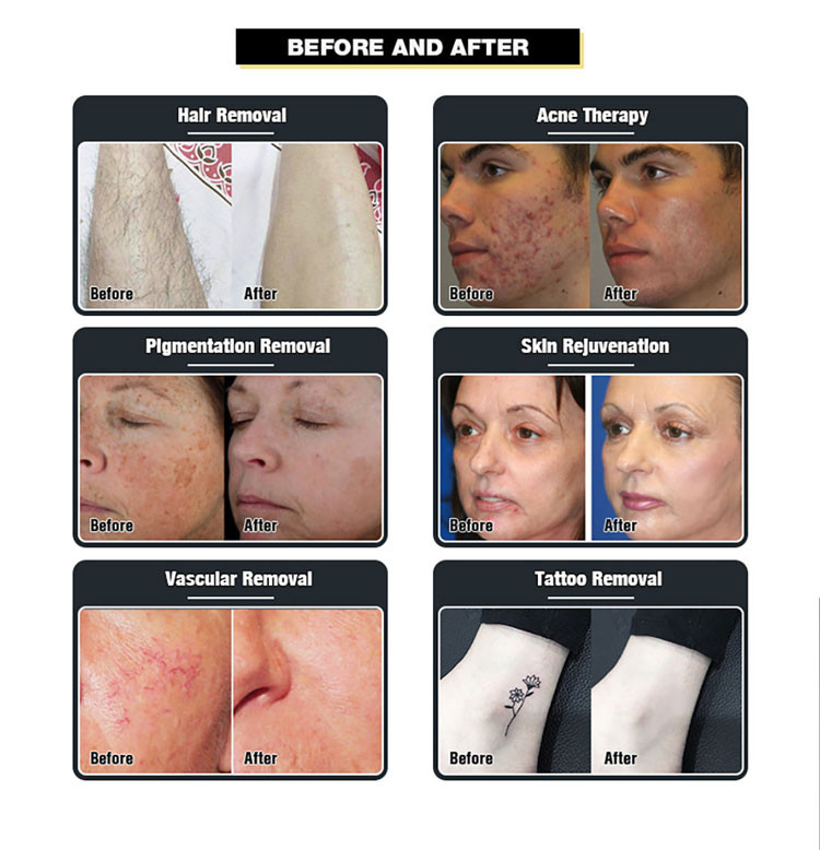 Picosecond Tattoo Diode Laser Hair Removal Machine 808nm Skin Rejuvenation