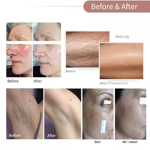 Dual Heads 7 Filters Ice Ipl Laser Hair Removal Machine Portable Hair Remover