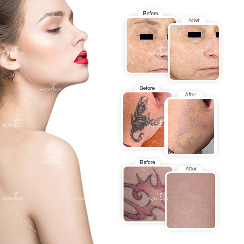 Candla Picosecond Laser Tattoo Removal Machine 3000W Acne Treatment