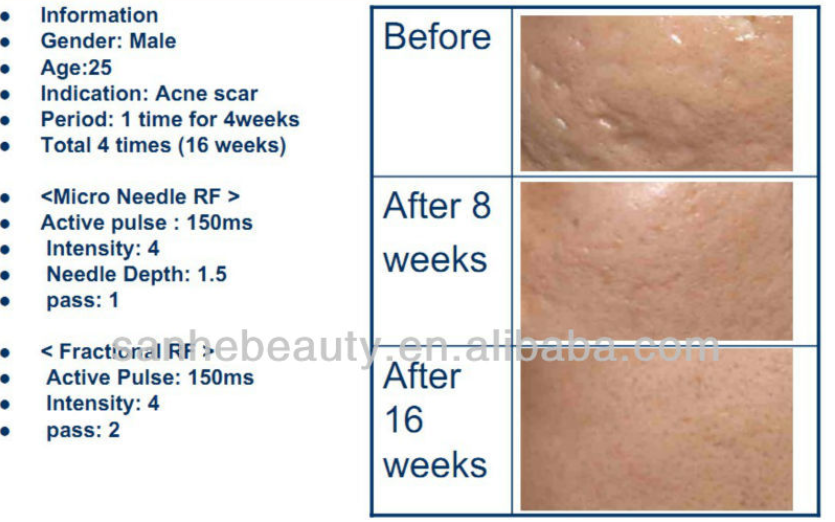 skin lifting machine fractional micro needles RF