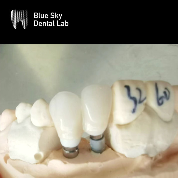 Layered Zirconia Implant Crown Zirconia Abutment Biocompatible