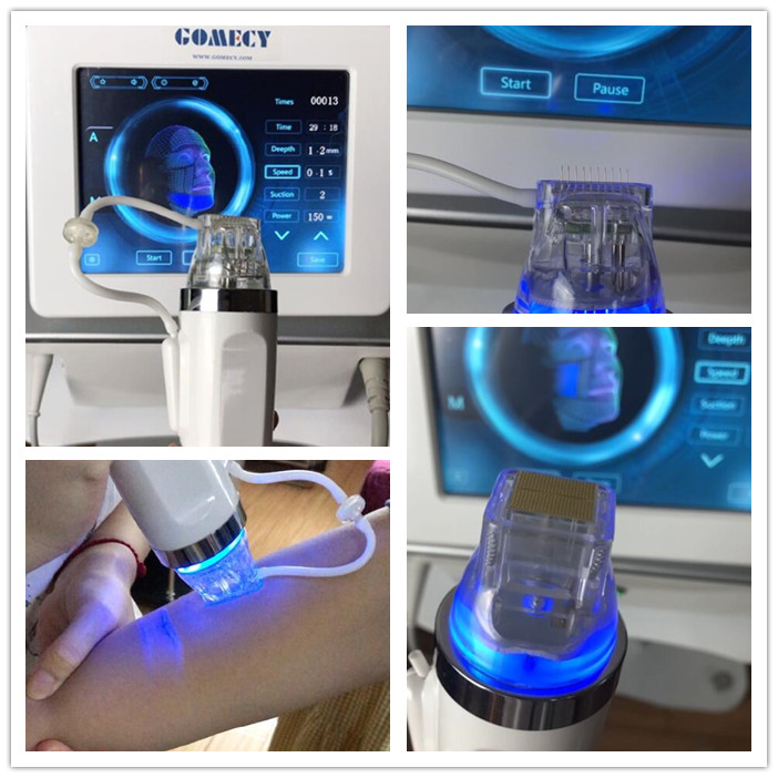 Professional Fractional Microneedle Face Lifting Rf Microneedling Machine