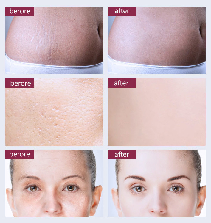 Fractional 10600 Nm Co2 Laser Skin Resurfacing Machine Stretch Marks Removal