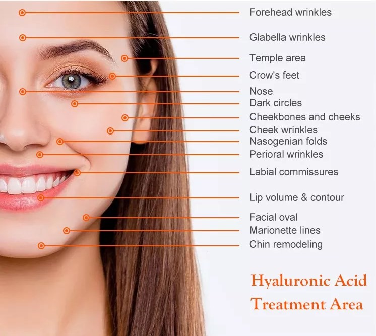 Long Lasting Injectable Cross Linked Dermal Fillers For Forehead Lines