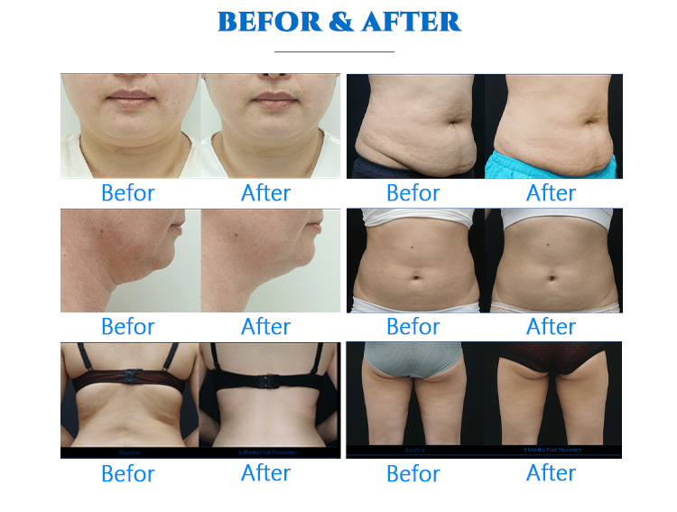 360 Degree Cryotherapy Cellulite Removal Cryolipolysis Slimming Machine Semi Conductor Cooling