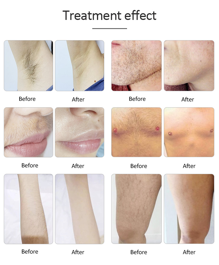 Portable 808nm Diode Laser Hair Removal Machine For Home