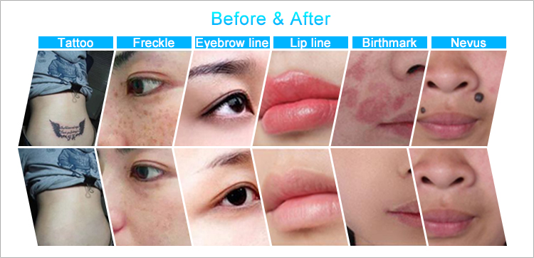 High Power Nd Yag Laser Tattoo Removal Beauty Equipment 1 Year Warranty