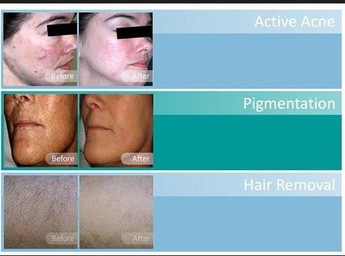 Hair Removal Laser IPL Machine Skin Rejuvenation Beauty Machine Pigment Removal