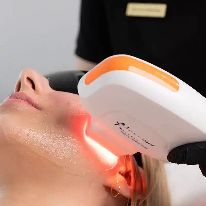 NIR Milk Light Whitening Ice 808nm Diode Laser Device 4 Wavelength 755 808 940 1064 Diode Laser Hair Removal Machine