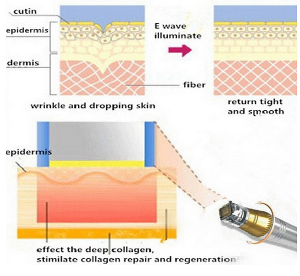 Discount price for nubway secret rf fractional microneedle for sale