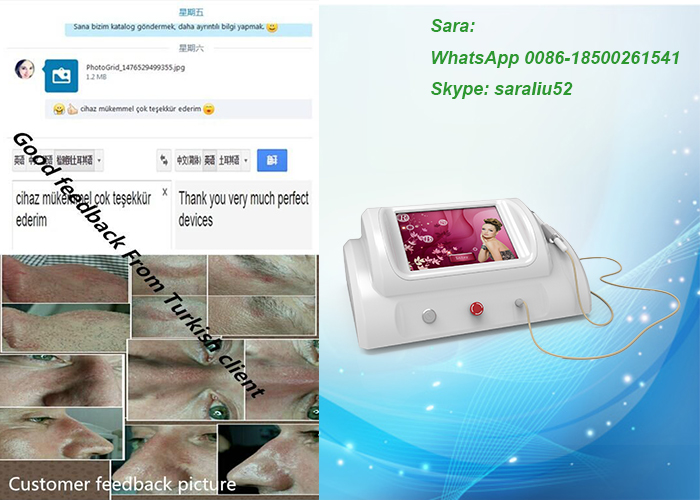 30MHz frequency Portable and white 0.01mm needles spider vein removal device with high quality/8.4 Inch skin tag removal