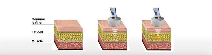 New product looking for distributor!!! CE approved high intensity focused ultrasound hifu for fat removal