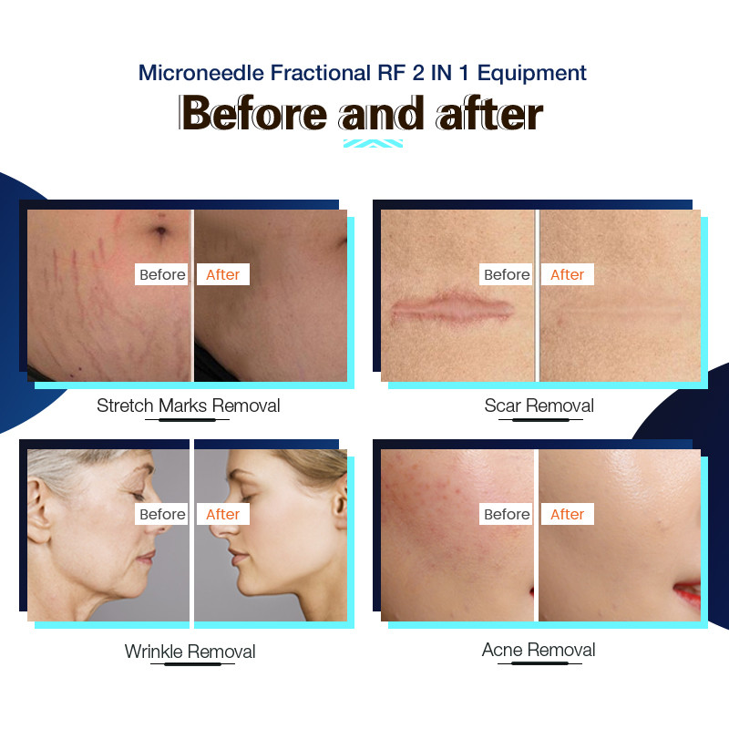 Portable 64 Pins RF Microneedling Machine / Radio Frequency Face Lift Device