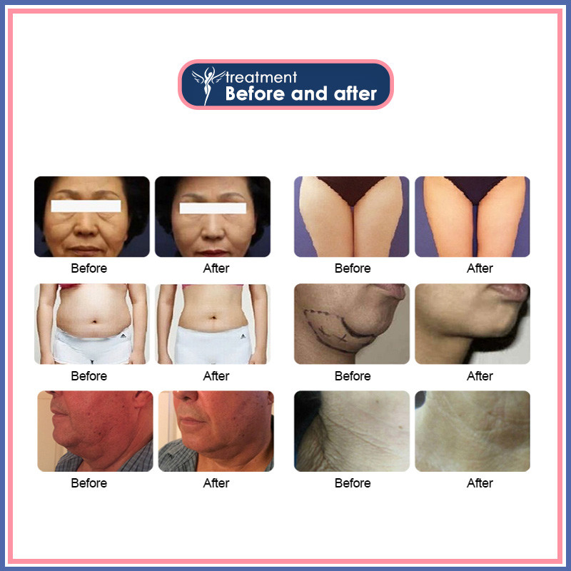 Face Skin Lifting Vaginal Tightening Machine HIFU Treatment Body Slimming