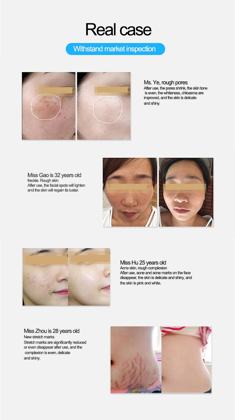 OEM Thermage Portable Rf Fractional Microneedle Monopolar RF Microneedling Machine