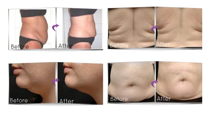 Multifunctional Skin Tightening RF Cavitation Slimming Machine 1 - 50J RF Energy