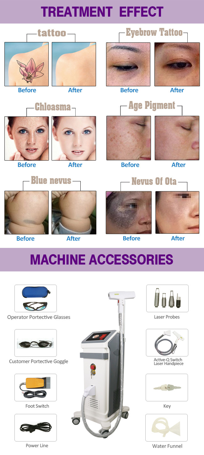 1000W 1064nm Q Switch Laser For Skin Lightening Tattoo Removal Nd Yag Laser Portable