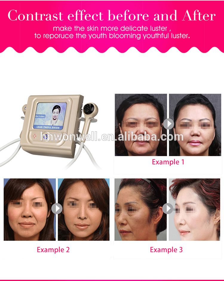face lifting thermolift machine