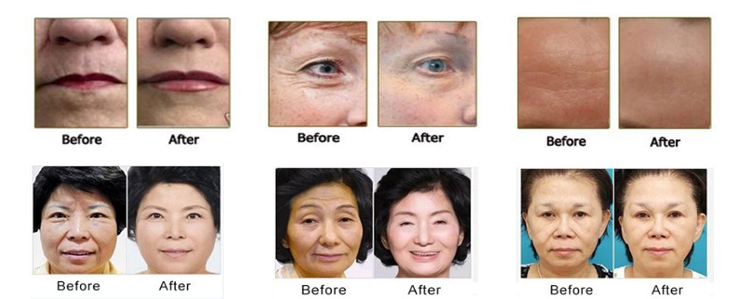 12 Lines HIFU Slimming Machine 3D Anti Wrinkle RF Firming Face