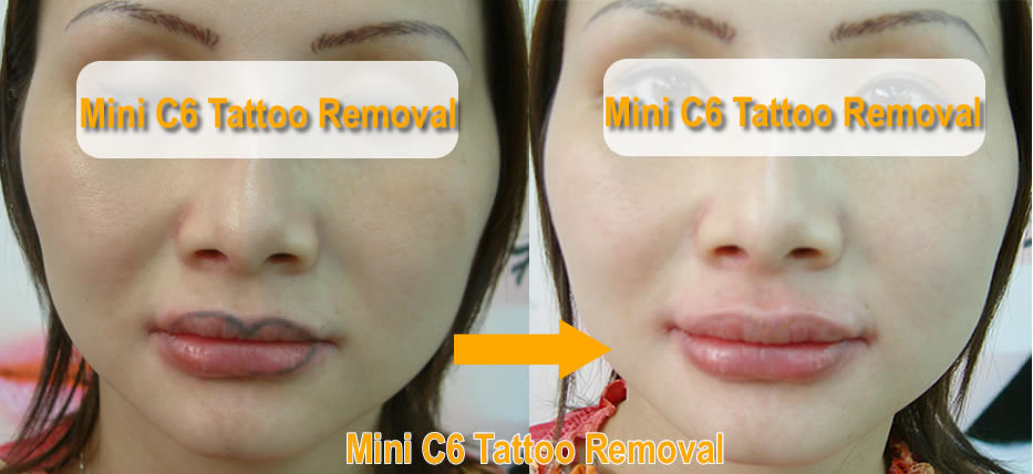 ND YAG Q - Switched Laser For Tattoo Removal With Close Loop Self Contained Water Air Cooling