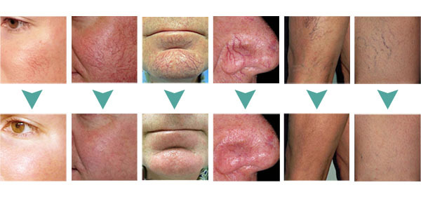 Telangiectasia removal machine immediate significant result