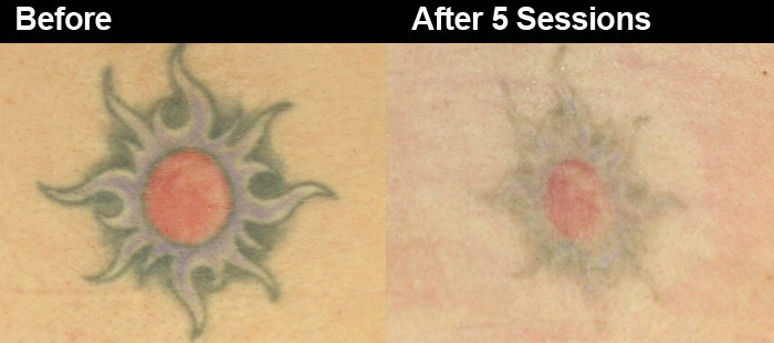 Professional q switched nd yag laser tattoo removal machine with CE approved 1064nm/532nm