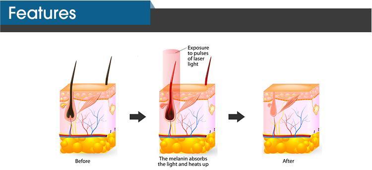 IPL DPL Skin Rejuvenation Machine , 4000W Laser Vascular Removal Machine