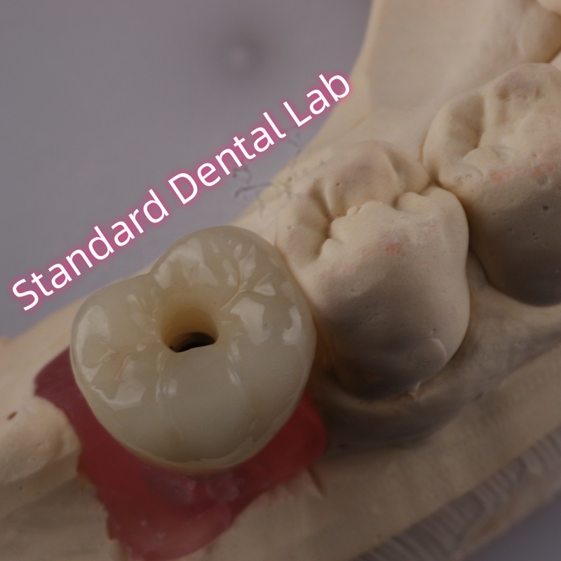 Screw Retained Dental Implant Crown PFZ Porcelain Layered Zirconia