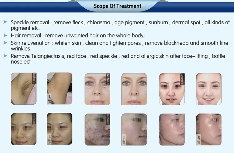 Hottest spa use!!!! powerful elight shr ipl machine for permanent hair removal intense pulsed light treatments