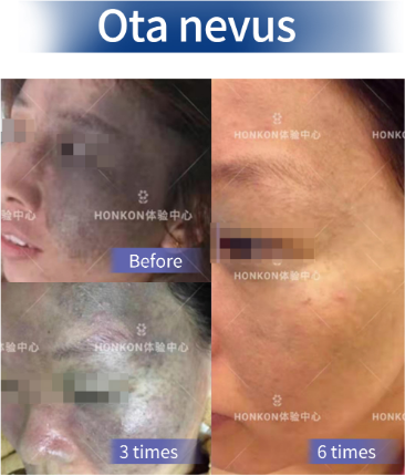 600ps Pulse Width 400mj Picosecond Laser Machine For Pigmentation 1
