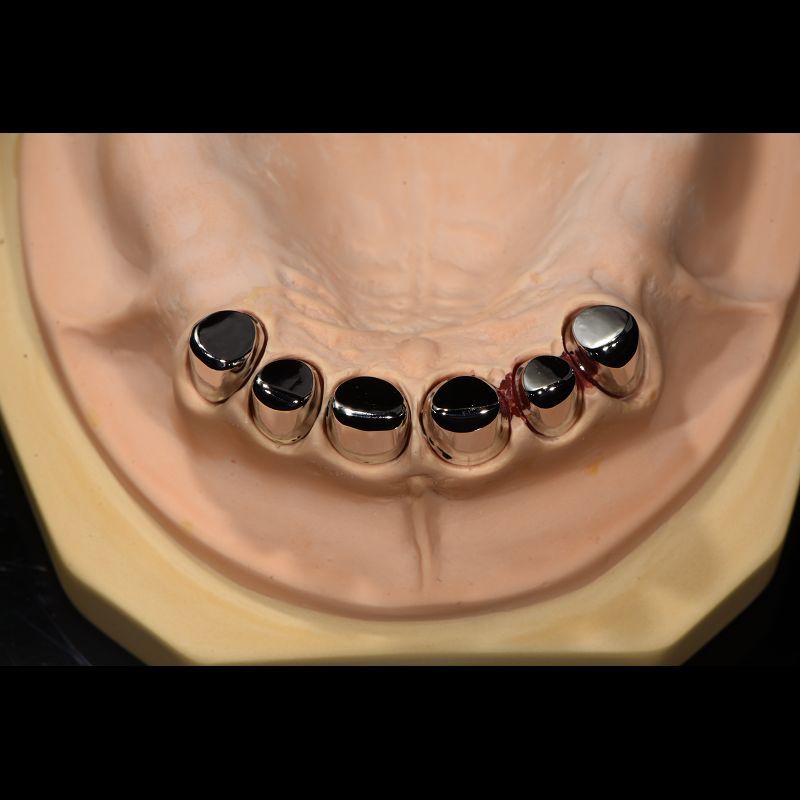 Removable Telescopic Partial Denture China Dental Lab For Missing Teeth