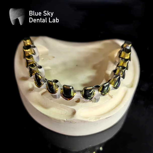 Pure Titanium Frame Malo Bridge Customizable Blue Sky Implant