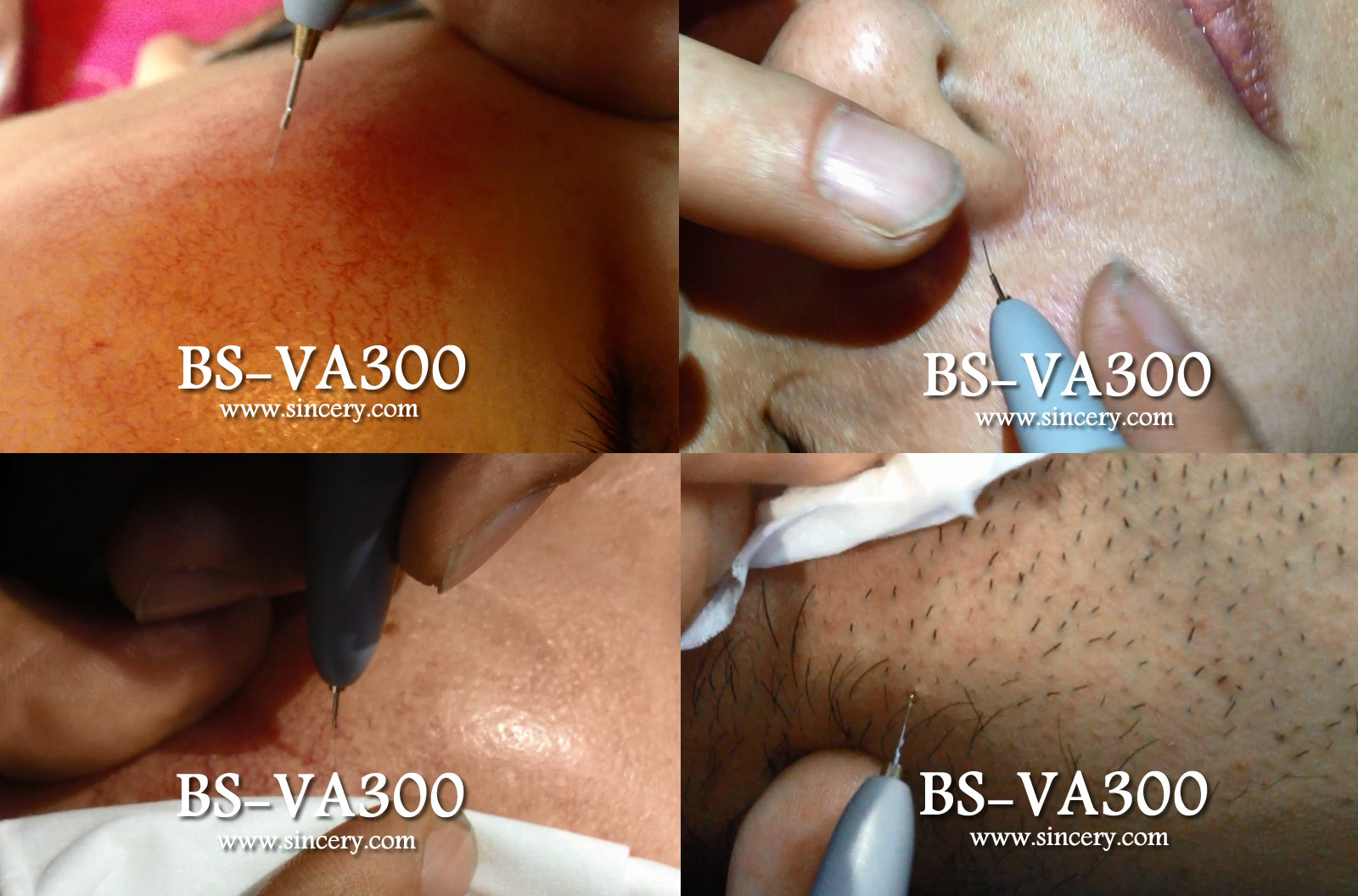 Professional Vascular Removal Machine , Spider Vein Removal Machine High Frequency