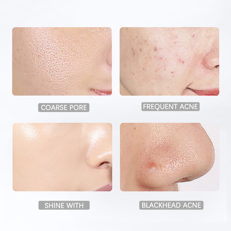 Hydrating 100ML Salicylic Acid Toner For Acne Oily Skin OEM ODM