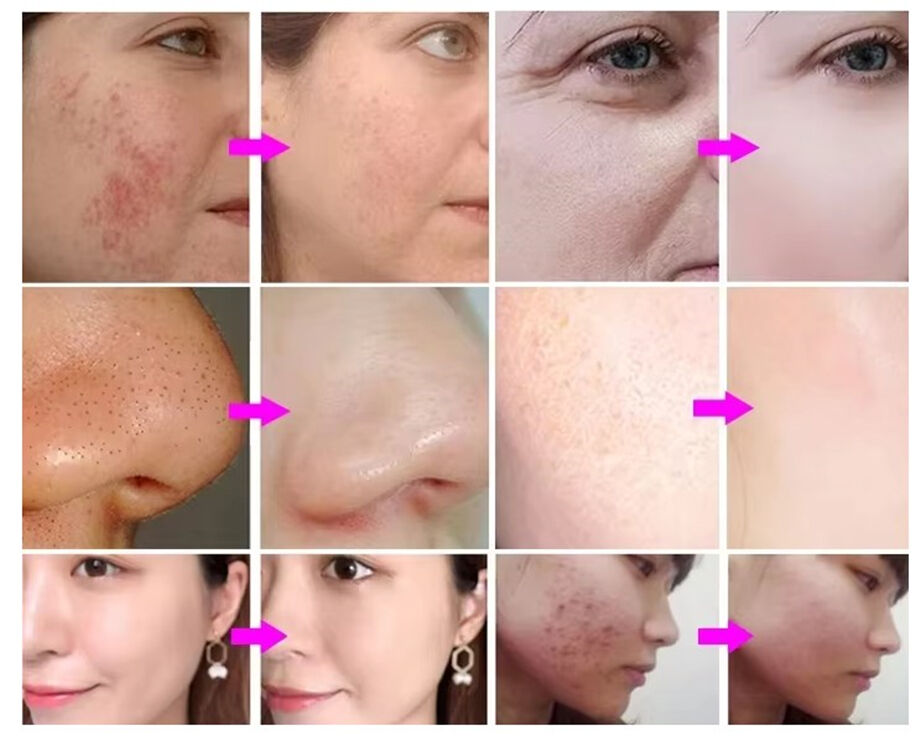 Facial Machines Face Cleaning Machine Anti-Wrinkle Water Oxgen Jetpeel