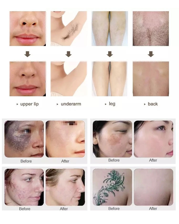 Medical Q Switched Nd Yag Laser Machine , Beauty Laser Tattoo Removal Machine