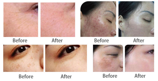 CE clinic Fractional RF Microneedling Machine Scar Removal Skin Regeneration