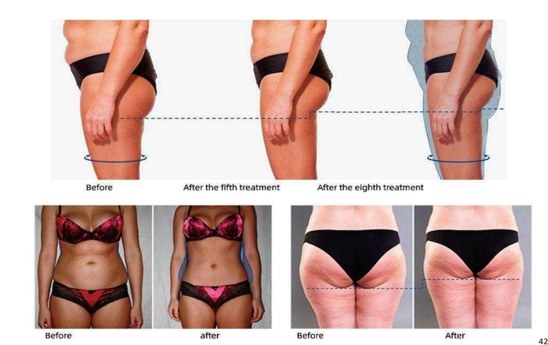 300W - 5000W Body Sculpt Machine ， Body Sculpting Equipment 3 - 200HZ