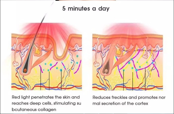 Portable IPL Hair Removal Machine