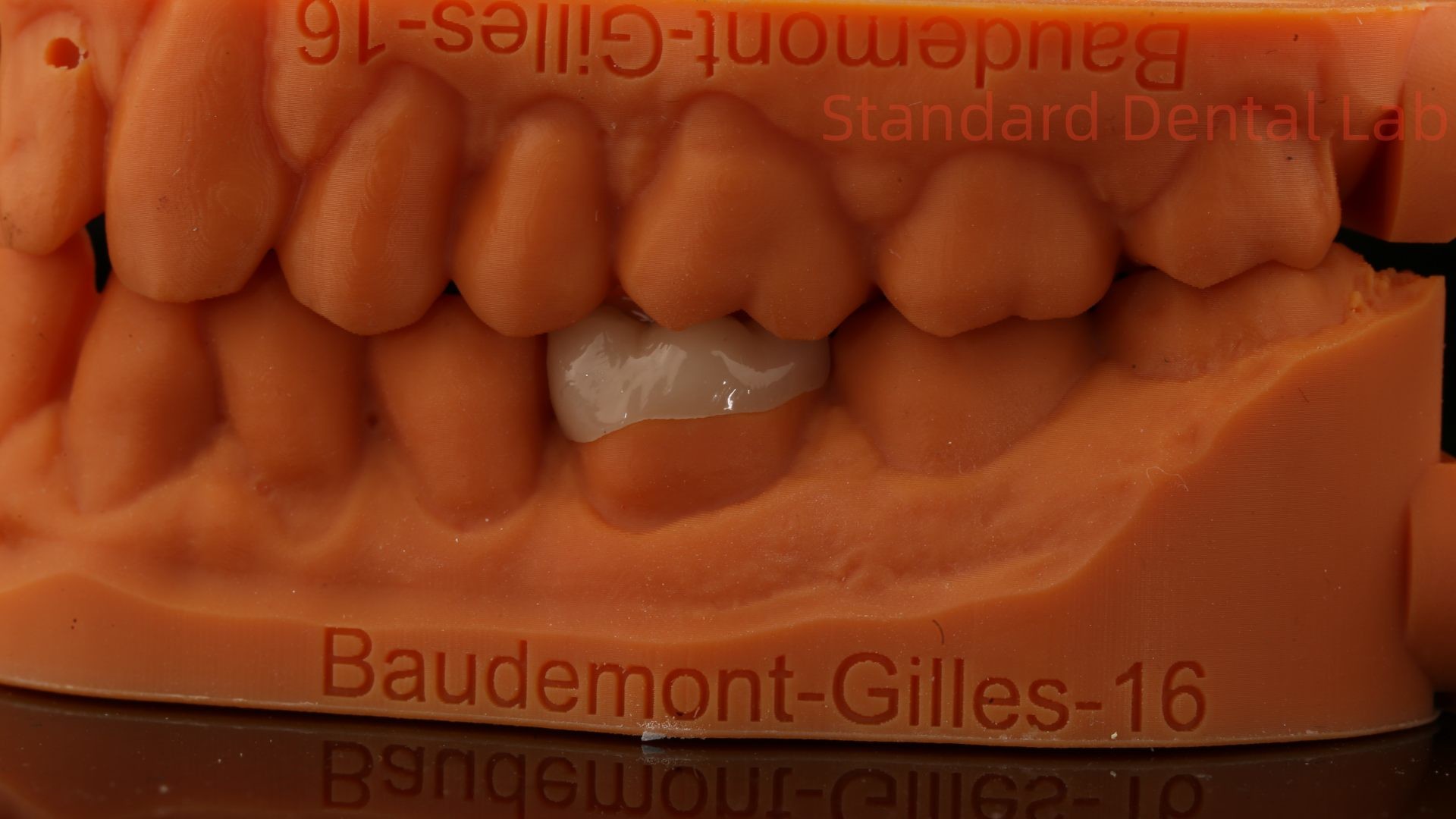 Strength Emax Ceramic Crown Dental Onlay with Excellent Stain Resistance China Dental Lab