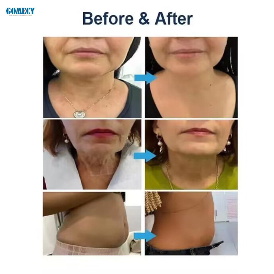12d Hifu Face Morpheus 8 Estiramiento De La Piel Hifu Vmax Machine Ice Hammer Focused Ultrasound Body Slimming Hifu
