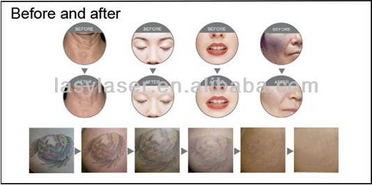 Home Use Laser Tattoo Removal Machine Multifunction Beauty For Beauty Salon