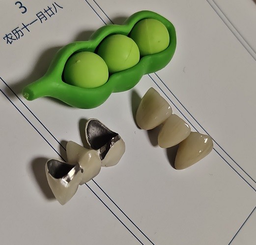 Metal Based Composite Hybrid PMMA Temporary Crown
