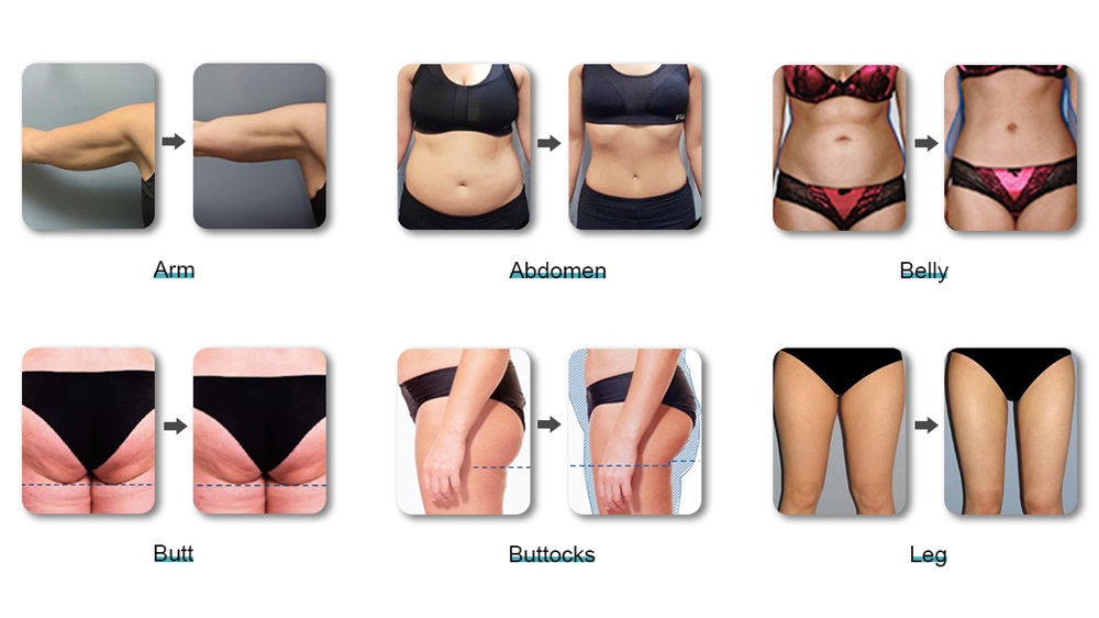Vertical Ems 2 Handles Body Sculpting Muscle Building RF Slimming Machine