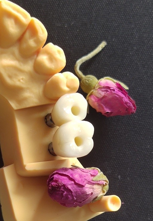 Cemented Implants Crowns Bridges