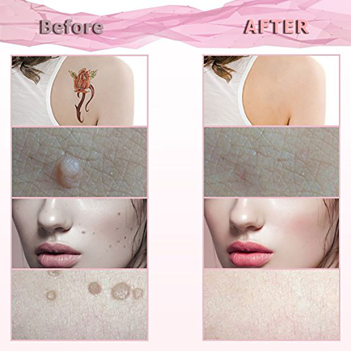 Rechargeable Portable Mole Removal Pen LCD Skin Mole Dark Spot Removal Pen