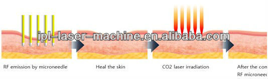 Fractional RF Microneedle Machine.jpg