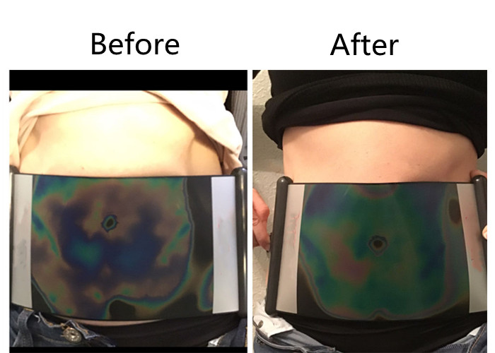 360 Degree Cryolipolysis Coolsculpting Machine Aesthetics Slimming