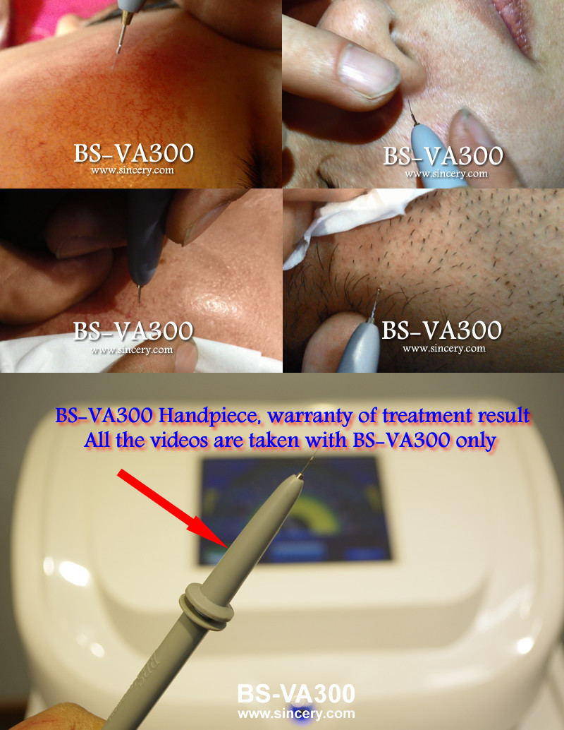 30MHz Vascular Removal Machine , Skin Tag Removal Machine With 1-100 Levels Energy